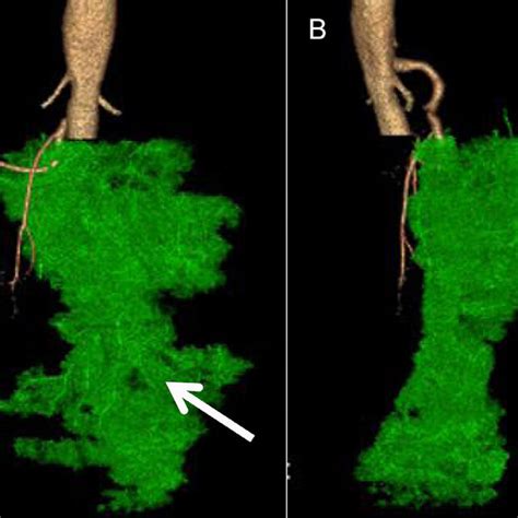 Volume Rendering Technique VRT Mesenteric Vessels White Arrow 2A