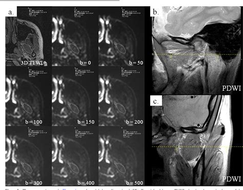 Figure 2 From The Intravoxel Incoherent Motion Mri Of Lateral Pterygoid Muscle A Quantitative