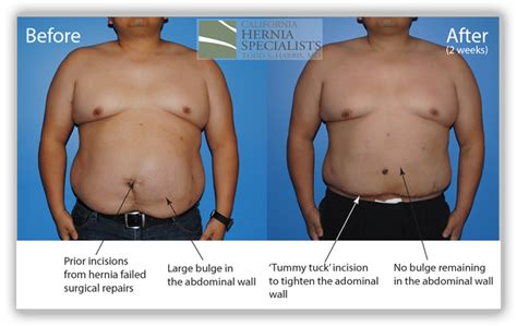 Hernia Types Umbilical California Hernia Specialists