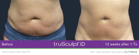 Trusculpt Before And After Pictures Muscle Sculpting And Fat Reduction