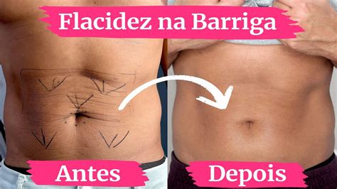 Reduzindo A FLACIDEZ Do ABDOMEN E O UMBIGO TRISTE BIOESTIMULADOR De