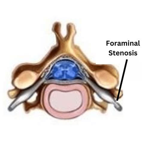 Spinal Stenosis Of Neck Symptoms (Cervical Spinal Stenosis)