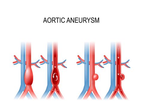 Aortic Aneurysm Stock Illustration - Download Image Now - iStock