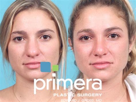 Rhinoplasty Before And After Pictures Case 909 Orlando Florida Primera Plastic Surgery