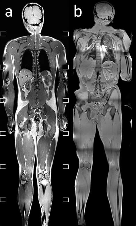 Essentials Of Forensic Post Mortem Mr Imaging In Adults Pmc