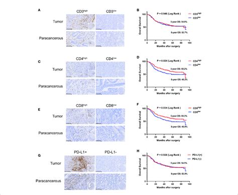 Tumor Infiltrating Lymphocytes Tils And Pd L1 Are Closely Related