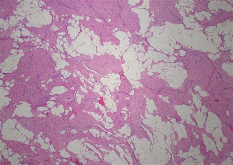 Subcutaneous Mass Rpathology