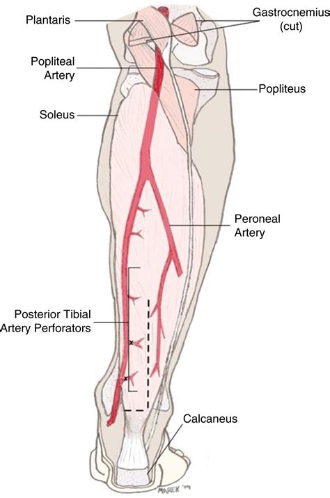 Leg Reconstruction Distal Third Local Flaps Clinical Tree