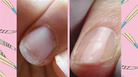 Uñas Quebradizas y Frágiles Causas y Soluciones Upsala Cosmetic