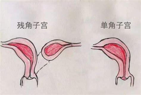 什么是残角子宫？残角子宫能怀孕吗？听听医生怎么说 知乎