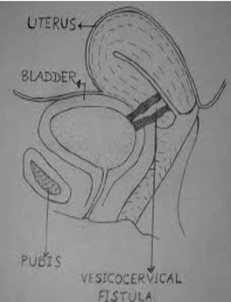 Figure 1 From Laparoscopic Repair Of Uterovesical Fistula Semantic