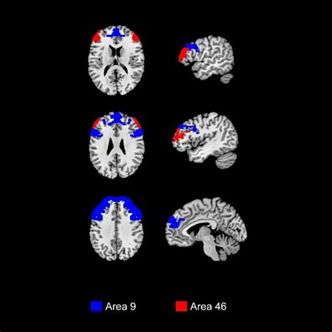 Dorsolateral Prefrontal Cortex Areas 9 46 Radiology Key