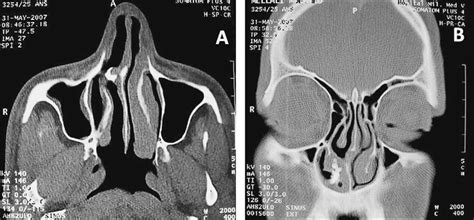 Maxillofacial Ct Scan On Axial A And Coronal B Views Demonstrated A