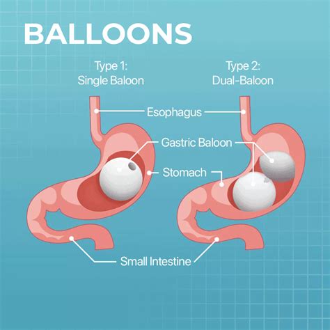 Gastric Balloons Turkey Medical Holidays