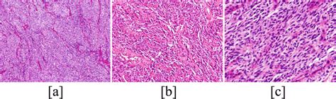 Histiological Findings Tumor Show Predominantly Monomorphic Spindle