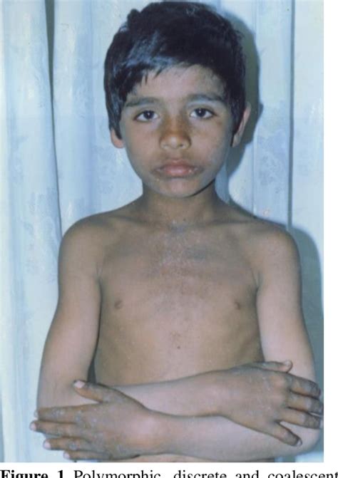 Figure 1 From Epidermodysplasia Verruciformis A Rare Genodermatosis