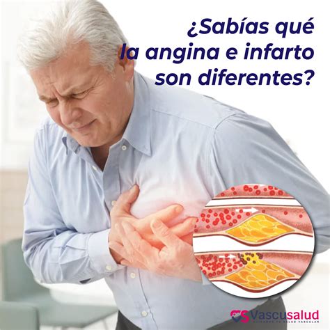 Sabías qué angina de pecho e infarto son diferentes