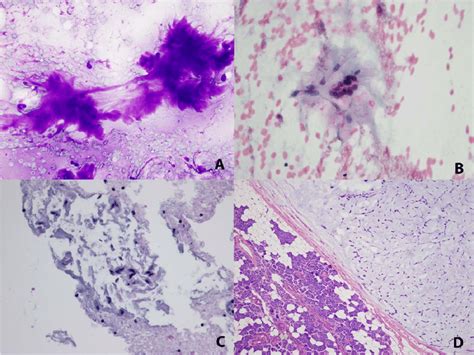 Fine Needle Aspiration Revealed Ovoid Cells With Bland Cytomorphologic