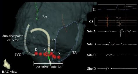 Ablation Points Of Cti And The Corresponding Local Potentials The