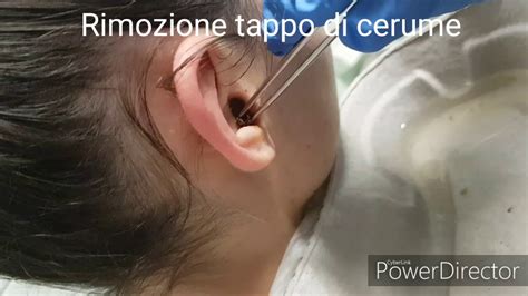 Come Rimuovere Il Tappo Di Cerume E Liberare Le Orecchie YouTube