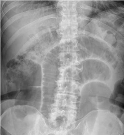 Surgical Abdominal Pain Flashcards Quizlet