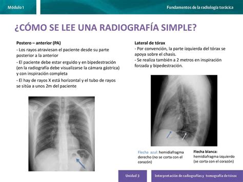 Interpretaci N De Radiograf As Y Tomograf A De T Rax Ppt Descargar