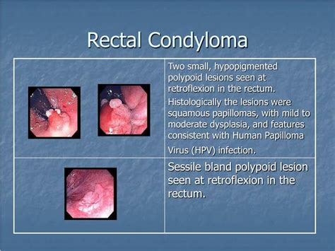 Rectal Polyps Symptoms