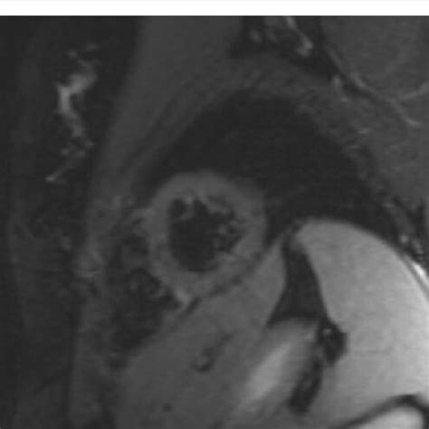 Resolution Of Prior Oedema Seen On Cardiac MRI Post Vaccination With