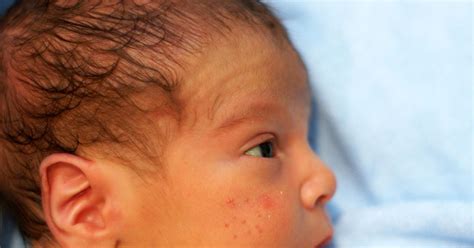 Baby acne FAQ: Symptoms, treatment and different types - Today's Parent