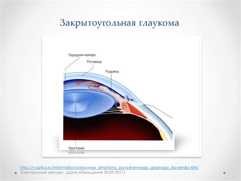Глаукома: клиника, диагностика - презентация онлайн
