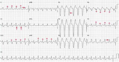 Av Nodal Reentrant Tachycardia Ecg