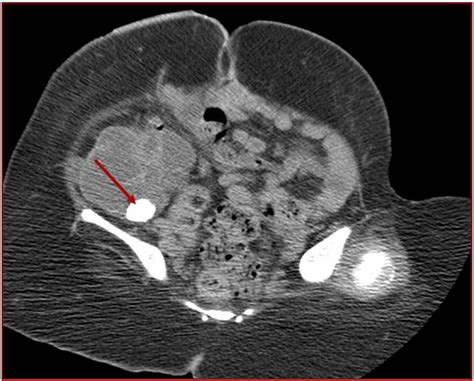 Diversion Ahead Imaging Appearance Of Urinary Diversions And