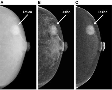 Frontiers Radiomic Analysis Of Contrast Enhanced Mammography With