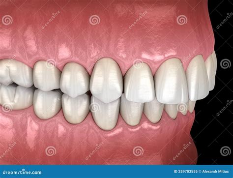 Overbite Dental Occlusion Malocclusion Of Teeth Medically Accurate