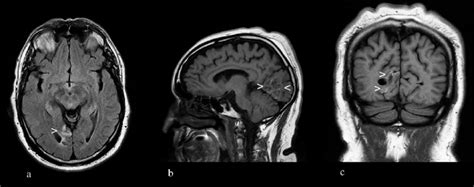 Brain MRI with and without contrast revealed haemosiderin (white ...