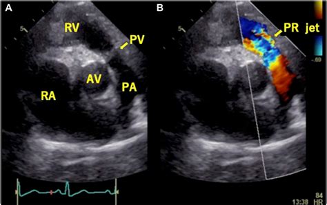 Two Dimensional Tte Basal Parasternal Short Axis View Diastolic Download Scientific Diagram