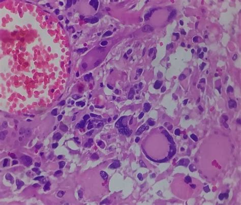 Neoplasm showing numerous multinucleated giant cells with bizarre... | Download Scientific Diagram