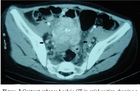 Figure From A Rare Case Of An Appendiceal Mass Masquerading As A