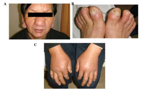 Leucemia Linfocítica Crónica Concise Medical Knowledge