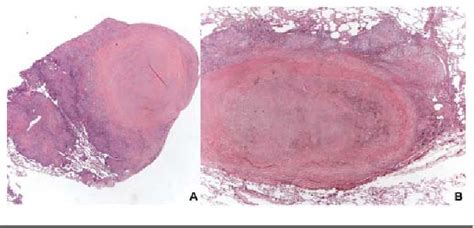 Figure From The Histology Of Pulmonary Sarcoidosis A Review With