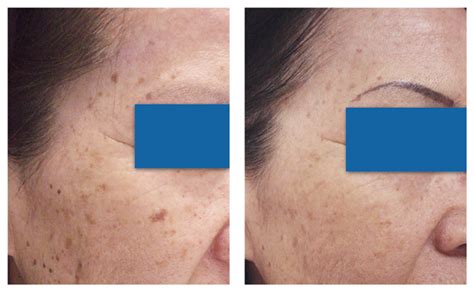 Skin Pigmentation Treatment And Removal Melbourne Dermacare Cosmetic