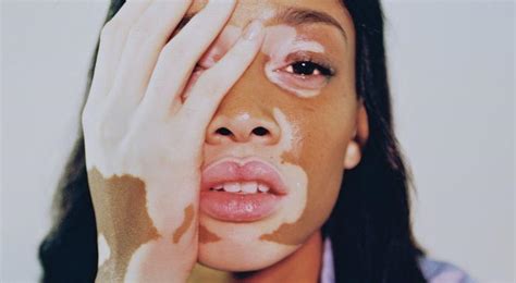 Qué es y por qué se produce el vitiligo Aquí te explicamos