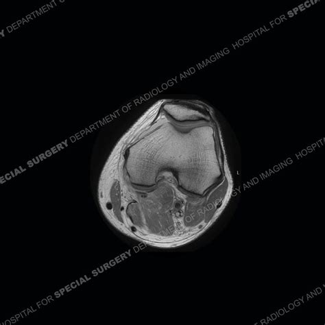 Hss Whats The Diagnosis Case 180 By Hospital For Special Surgery Issuu