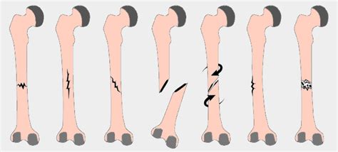 Tipos De Fracturas Guía Ilustrada Guía Tu Cuerpo