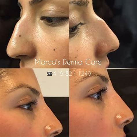 Filler Nose Job Before And After William Hubert