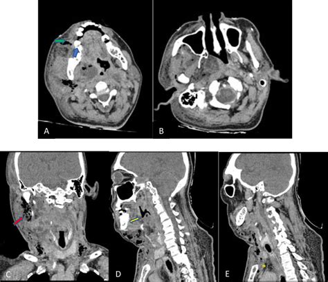 A Contrast Ct Scan Of The Necks Soft Tissue A Periapical Abscess Download Scientific