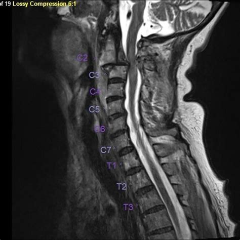 Post Operative T2 Weighted Sagittal MRI Of The Cervical Spine