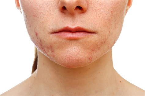 Trattamento Acne A Catanzaro Dott Ssa Lacava