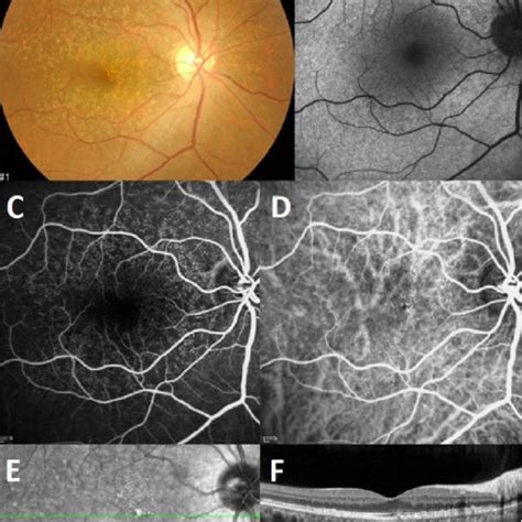 Macular Complications Of Cuticular Drusen A Geographic Atrophy Is