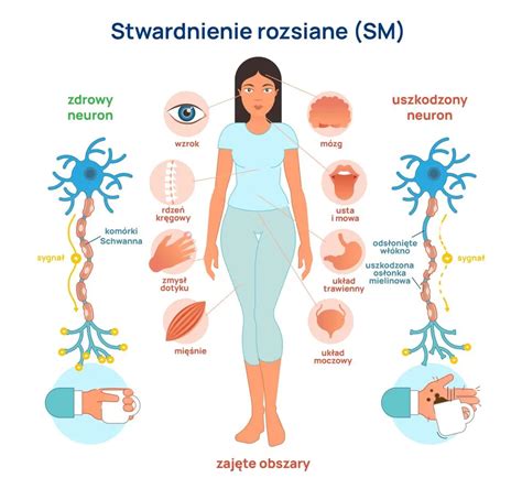 Stwardnienie rozsiane groźna i podstępna choroba